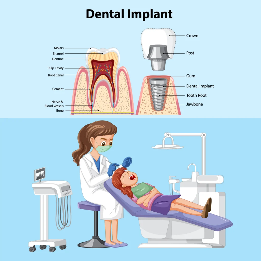 Root Canal Treatment